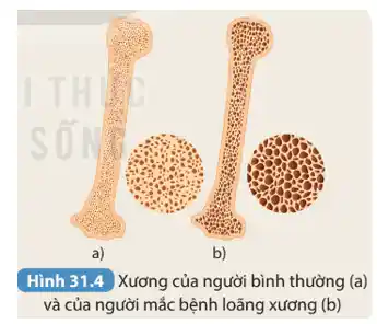 Hình 31.4 Xương của người bình thường (a)
và của người mắc bệnh loãng xương (b)